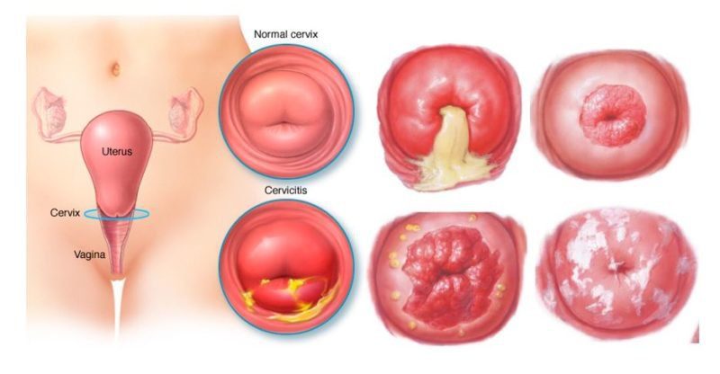 Sự khác nhau giữa viêm lộ tuyến và viêm lộ tuyến cổ tử cung