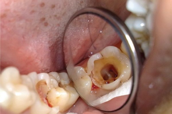 Đau răng do sâu răng