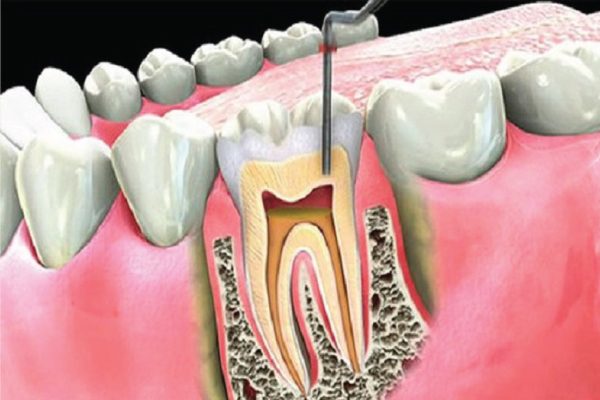 Đau răng do viêm tủy răng