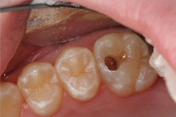 Viêm tủy răng gây đau răng