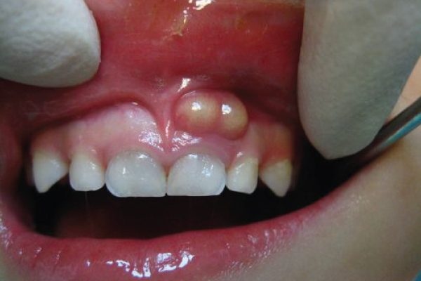 sưng nướu răng