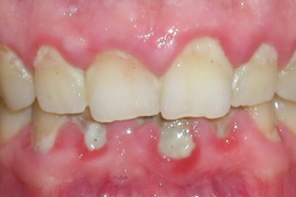 Nhiễm trùng nướu răng