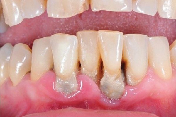 Răng và ổ xương răng bị phá hủy