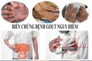 Biến Chứng Bệnh Gout
