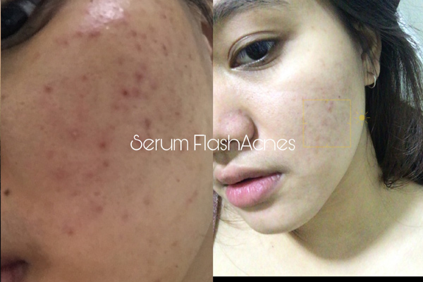 serum-flash-acnes-co-tot-khong
